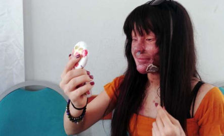 Berfin Özek yüzüne asit atan sevgilisini affetti!