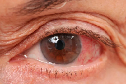 Tek gözünüz kanlanıyorsa dikkat!