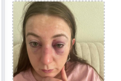 Eski erkek arkadaşı tarafından darp edildi