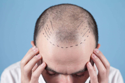 Türkiye saç ekimi konusunda dünyanın en iyi ülkesi