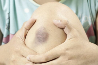 “Vücuttaki çürük ve morarmalar lösemi işareti olabilir”