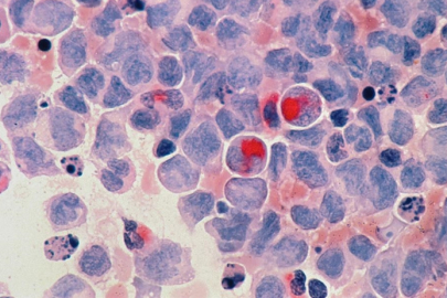 Lenf kanserleri ve akut lösemilerde erken tedavi önem taşıyor