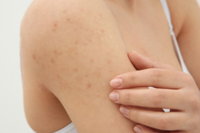 Şiddetli gece kaşıntısı uyuz belirtisi olabilir