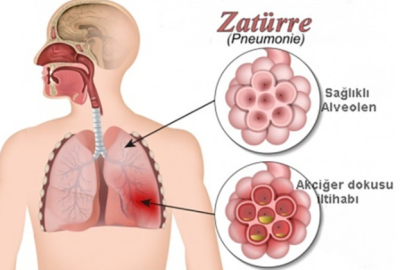 “Zatürre Türkiye’de ölüm nedenleri arasında 5’inci sırada”