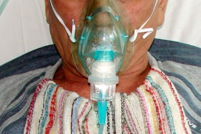 Solunum sistemi hastalığında KAOH etkisi