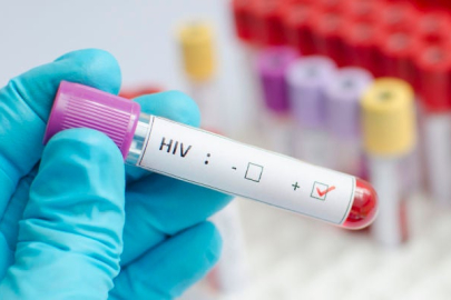 HIV enfeksiyonunu kontrol altına almak mümkün