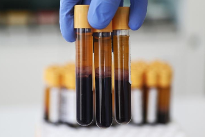 Kan testiyle hızlı ve yavaş yaşlanan organlar tespit edilebilir