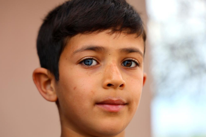 Hayata çift renk bakıyor, görenler hayrete düşüyor