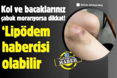 Kol ve bacaklarınız çabuk morarıyorsa dikkat! ‘Lipödem habercisi olabilir