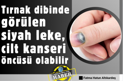 Tırnak dibinde görülen siyah leke, cilt kanseri öncüsü olabilir 