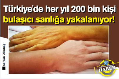 Türkiye'de her yıl 200 bin kişi bulaşıcı sarılığa yakalanıyor! 