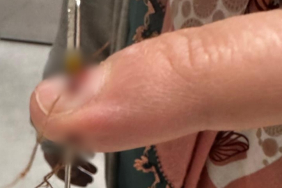 Eline dikiş iğnesi saplanan kadın hastanelik oldu
