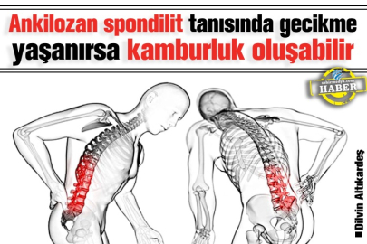 Ankilozan spondilit tanısında gecikme yaşanırsa kamburluk oluşabilir