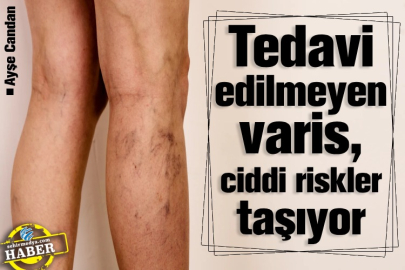 Tedavi edilmeyen varis, ciddi riskler taşıyor