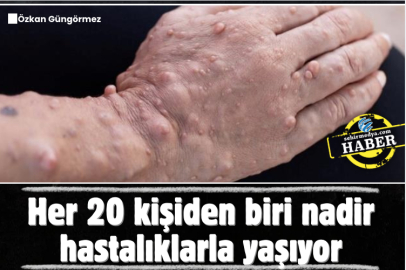 Her 20 kişiden biri nadir hastalıklarla yaşıyor
