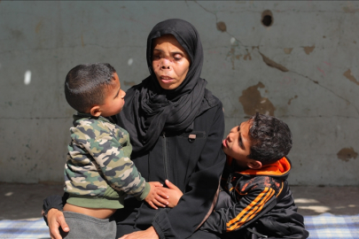 İsrail saldırısında yüzünün bir kısmını kaybeden Gazzeli annenin tek dileği çocuklarının korkmadan ona sarılması