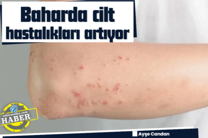 Baharda cilt hastalıkları artıyor