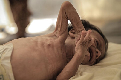 Bangladeş'te 15 Mart'tan bu yana kızamık olduğu doğrulanan veya belirtileri görülen 528 çocuk öldü